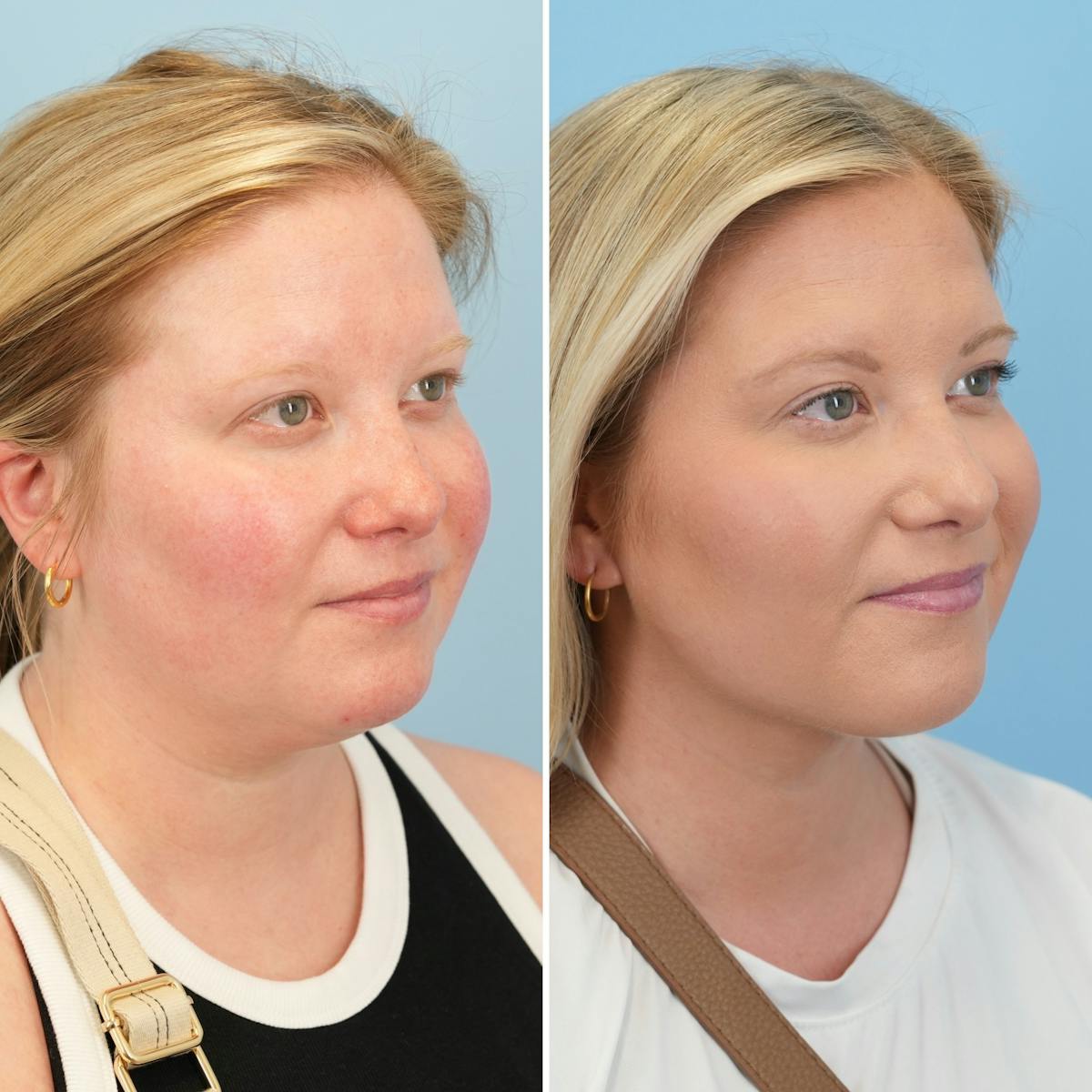 Submental Liposuction Before & After Gallery - Patient 148497 - Image 4