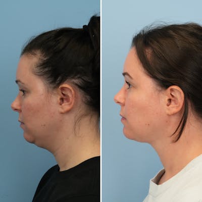 Submental Liposuction Before & After Gallery - Patient 339031 - Image 1