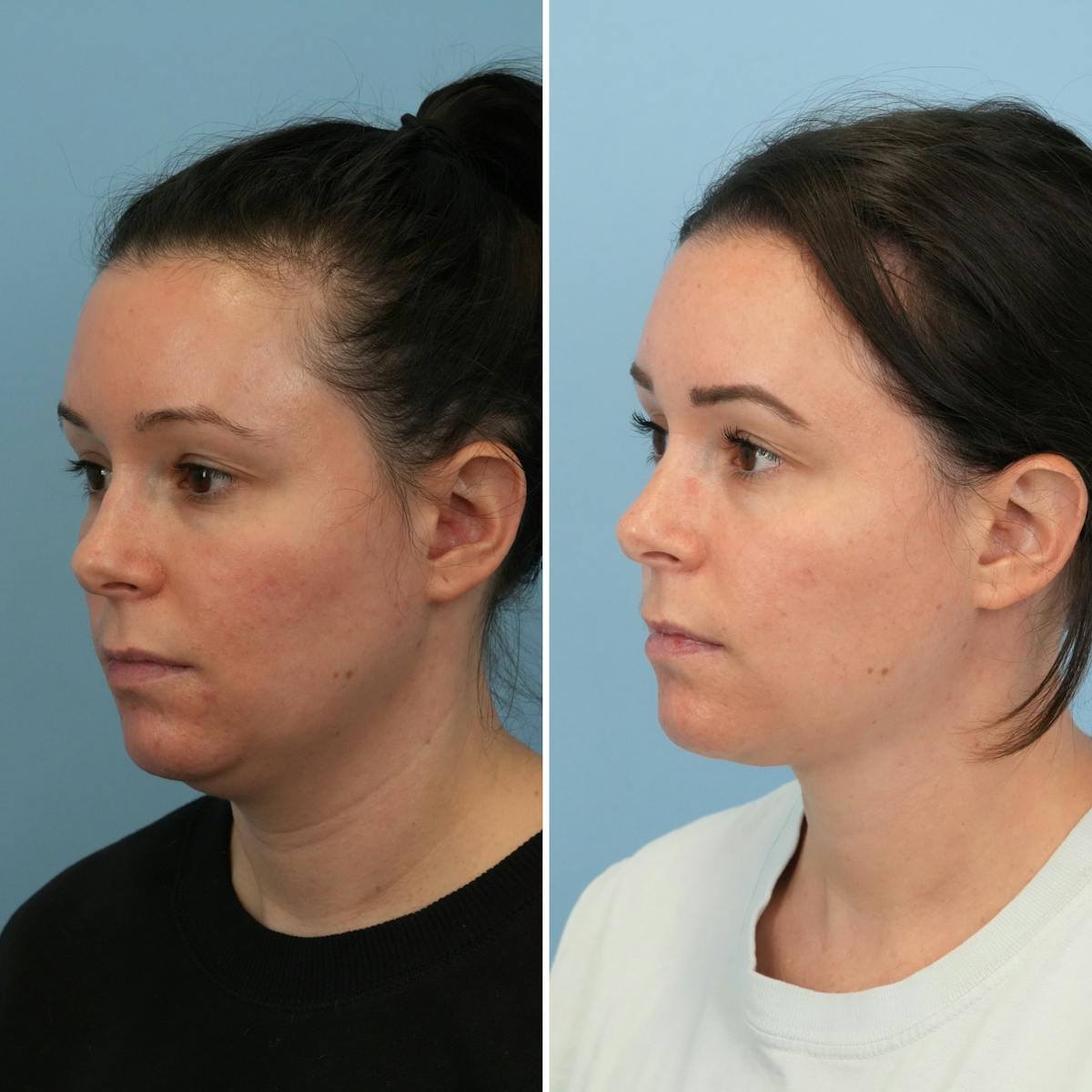 Submental Liposuction Before & After Gallery - Patient 339031 - Image 2