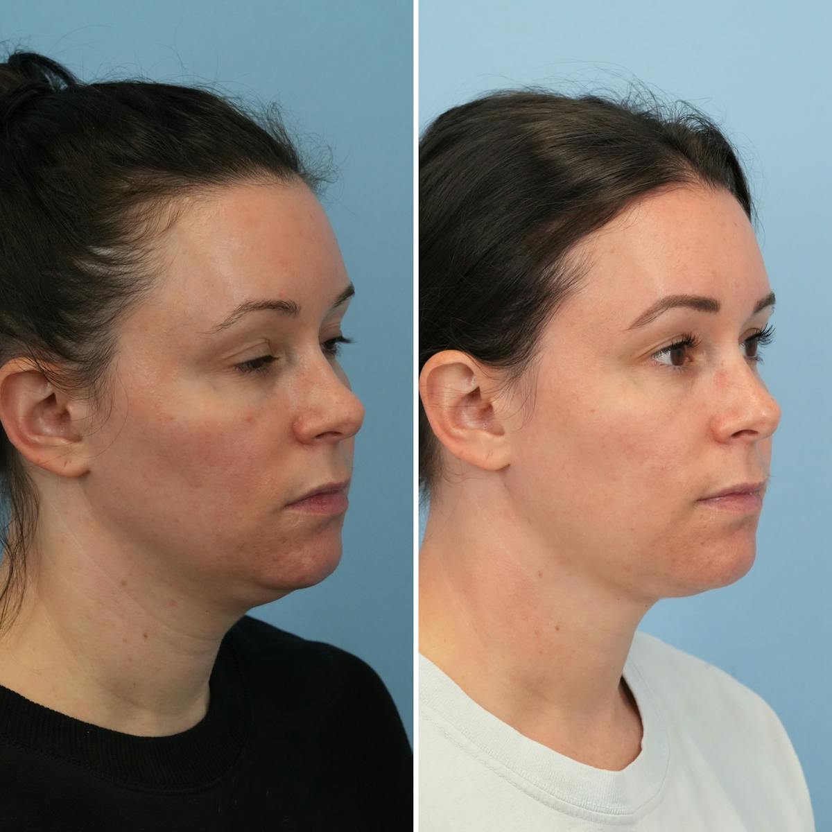 Submental Liposuction Before & After Gallery - Patient 339031 - Image 3