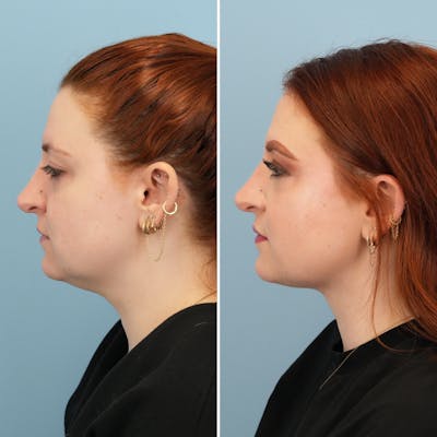 Submental Liposuction Before & After Gallery - Patient 150283 - Image 1