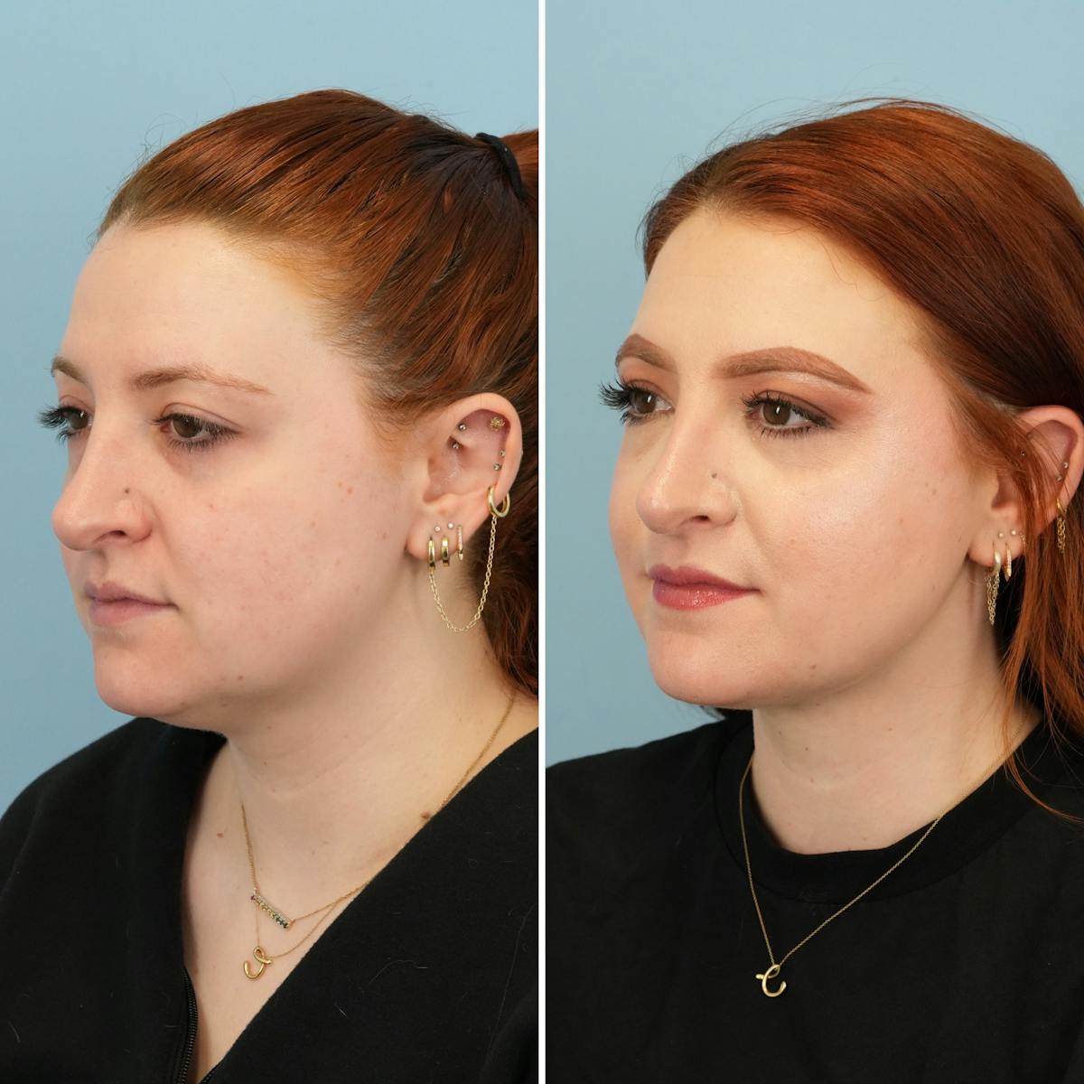 THERMItight Before & After Gallery - Patient 918847 - Image 2