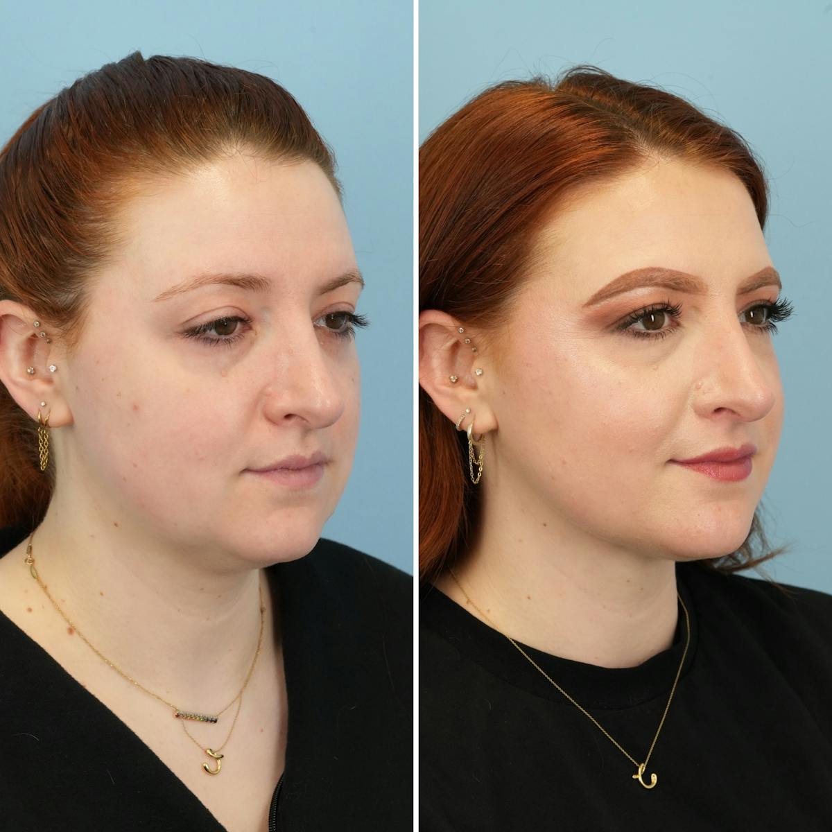 THERMItight Before & After Gallery - Patient 918847 - Image 5