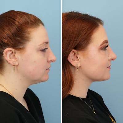 THERMItight Before & After Gallery - Patient 918847 - Image 1