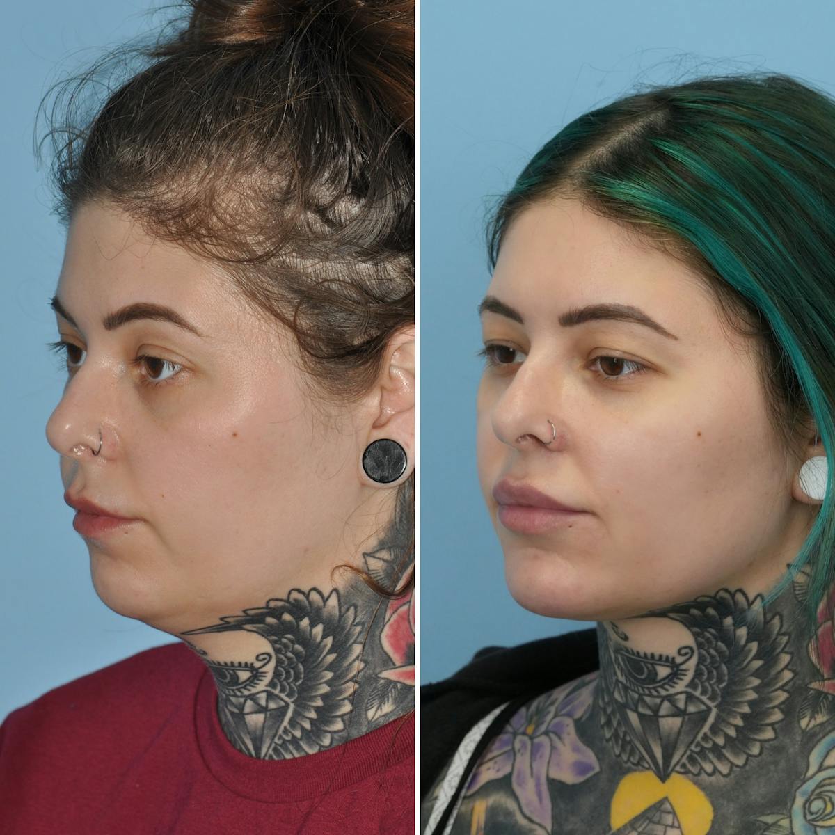 Submental Liposuction Before & After Gallery - Patient 247112 - Image 2