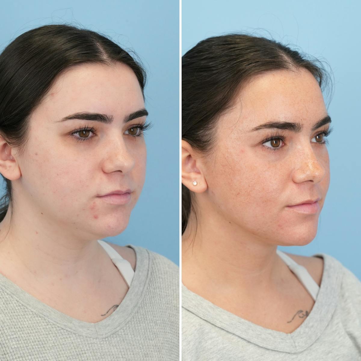 Submental Liposuction Before & After Gallery - Patient 275943 - Image 4