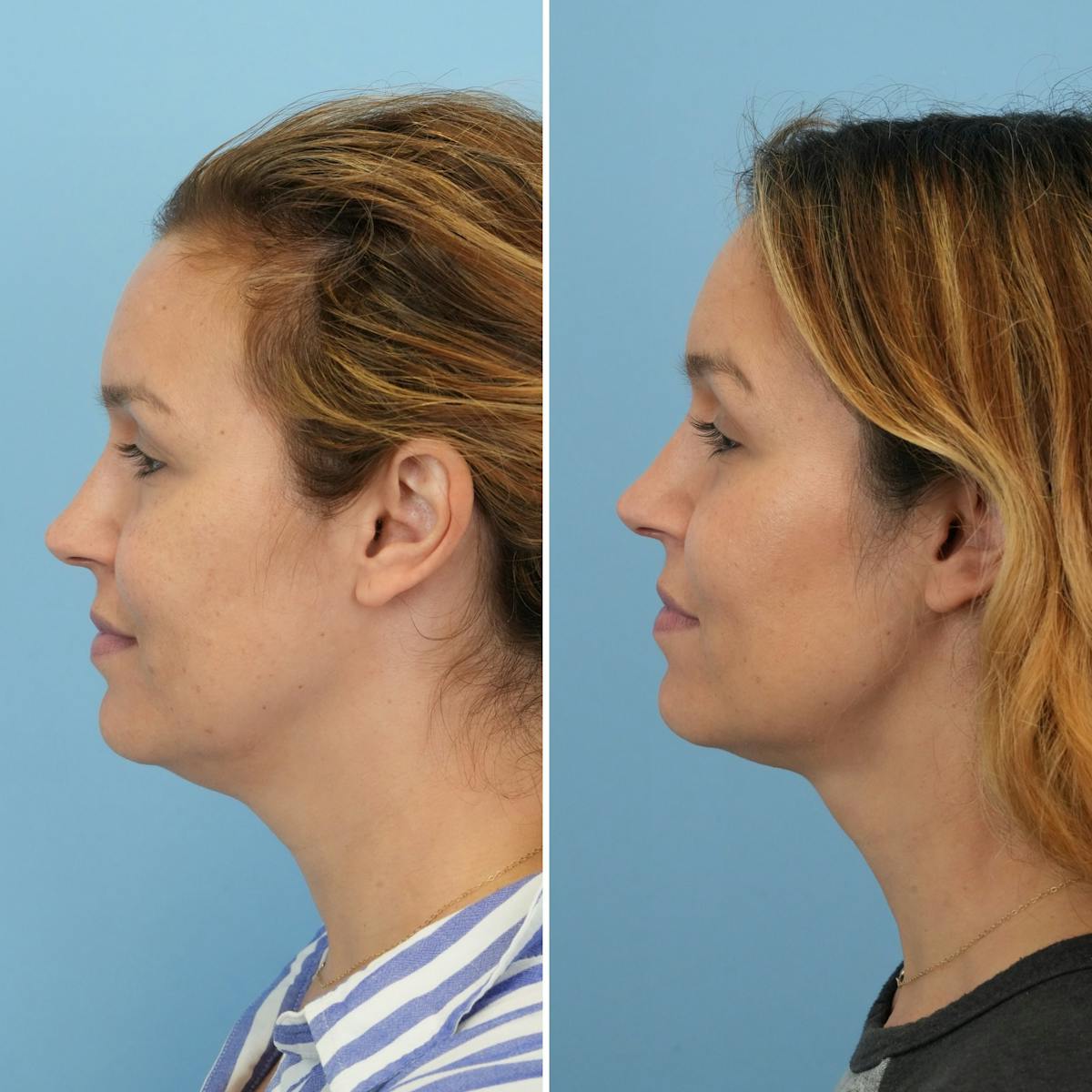 Submental Liposuction Before & After Gallery - Patient 693594 - Image 1