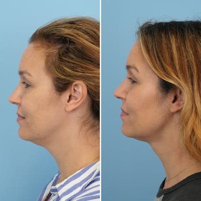 Submental Liposuction Before & After Gallery - Patient 693594 - Image 1
