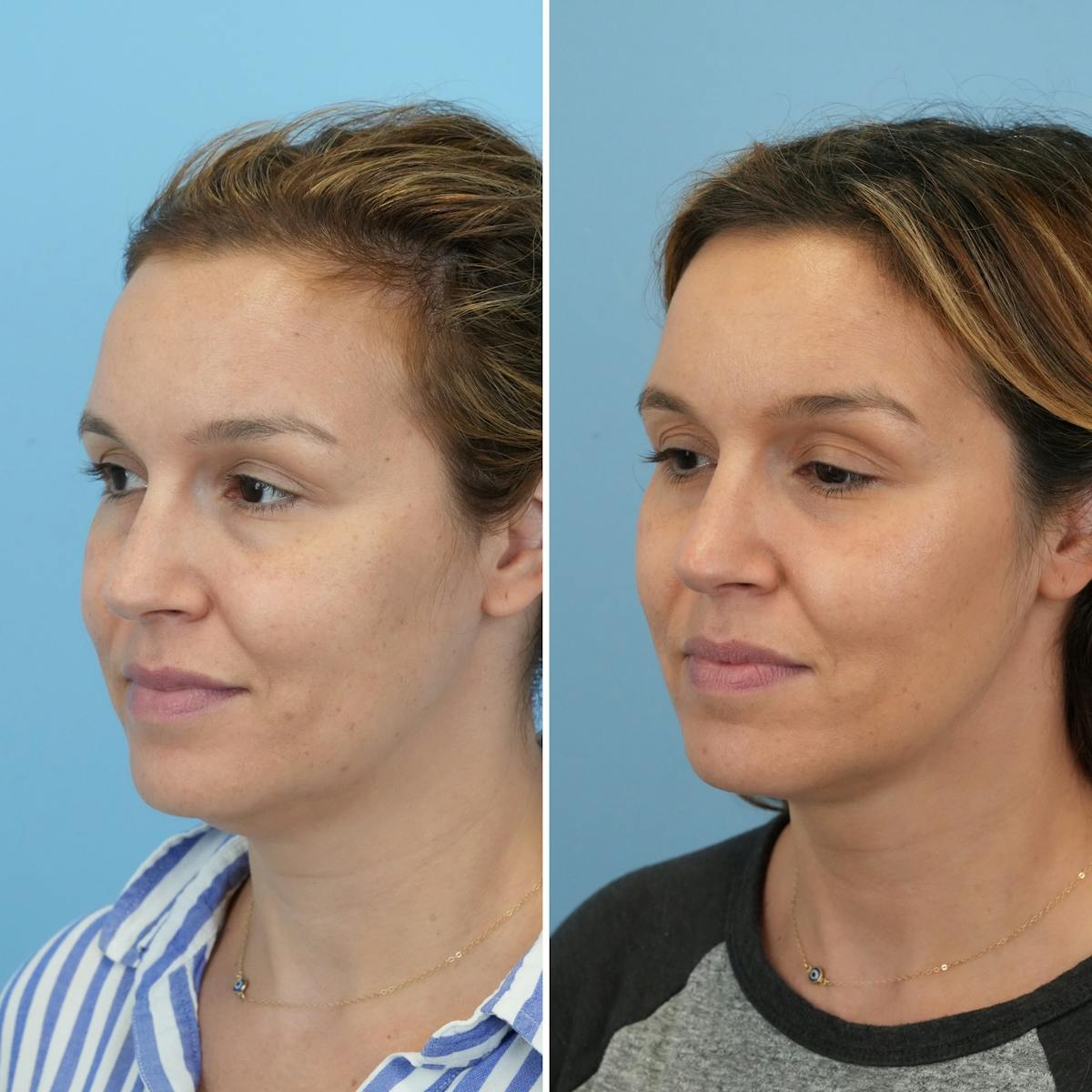 Submental Liposuction Before & After Gallery - Patient 693594 - Image 2