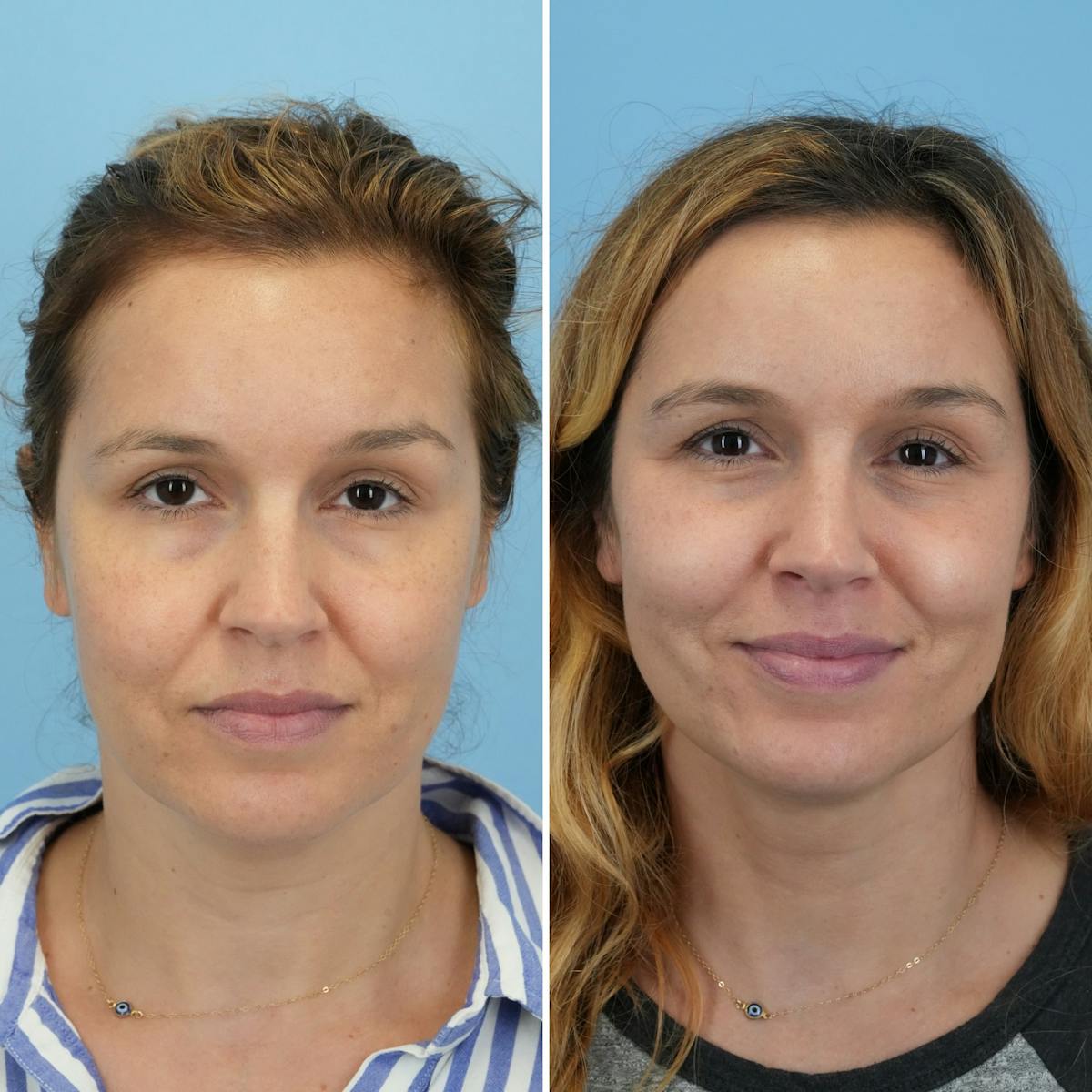 Submental Liposuction Before & After Gallery - Patient 693594 - Image 3