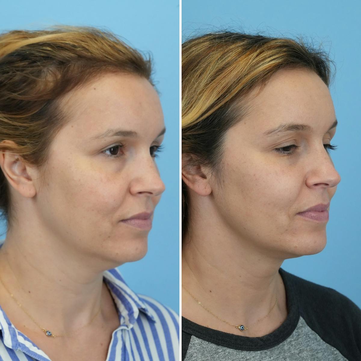 Submental Liposuction Before & After Gallery - Patient 693594 - Image 4