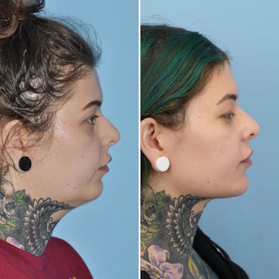 THERMItight Before & After Gallery - Patient 170074 - Image 1