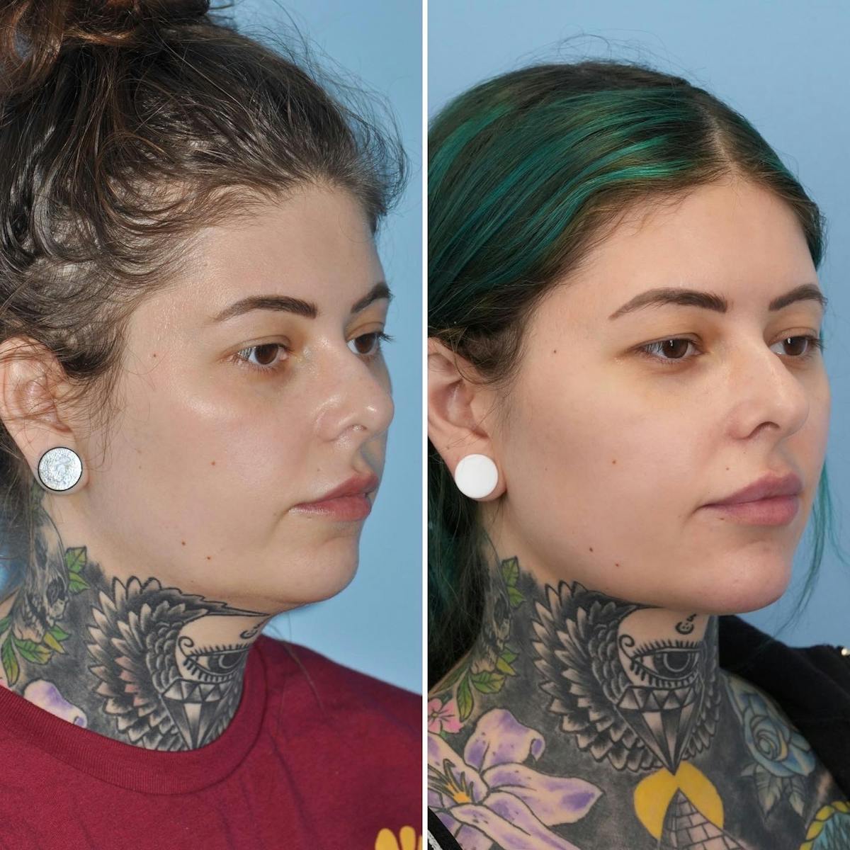 THERMItight Before & After Gallery - Patient 170074 - Image 2