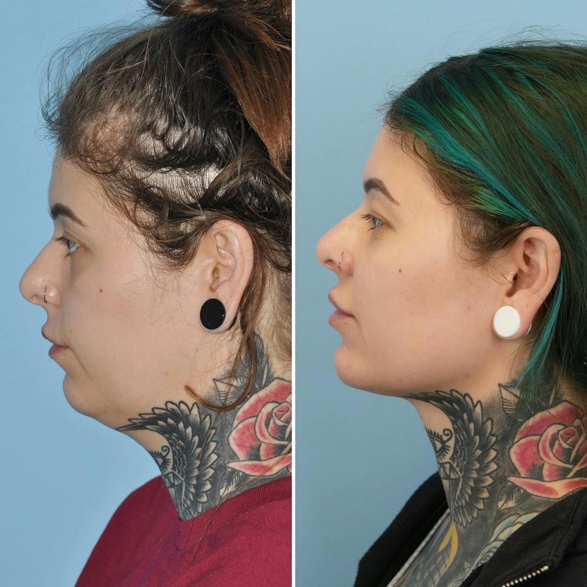 THERMItight Before & After Gallery - Patient 170074 - Image 3