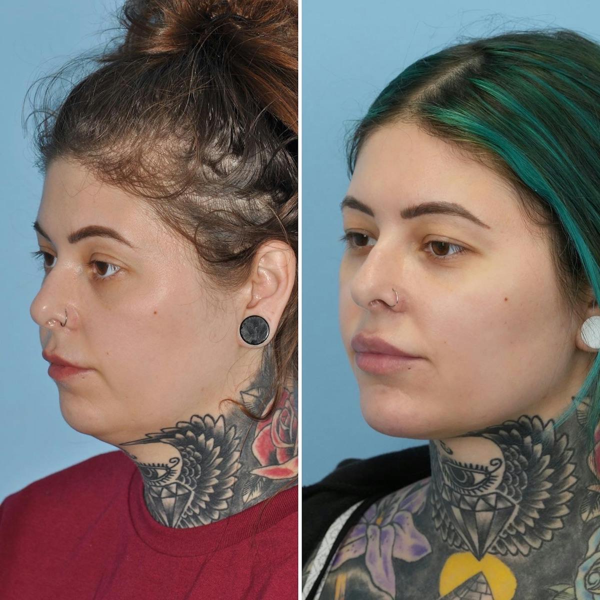 THERMItight Before & After Gallery - Patient 170074 - Image 4
