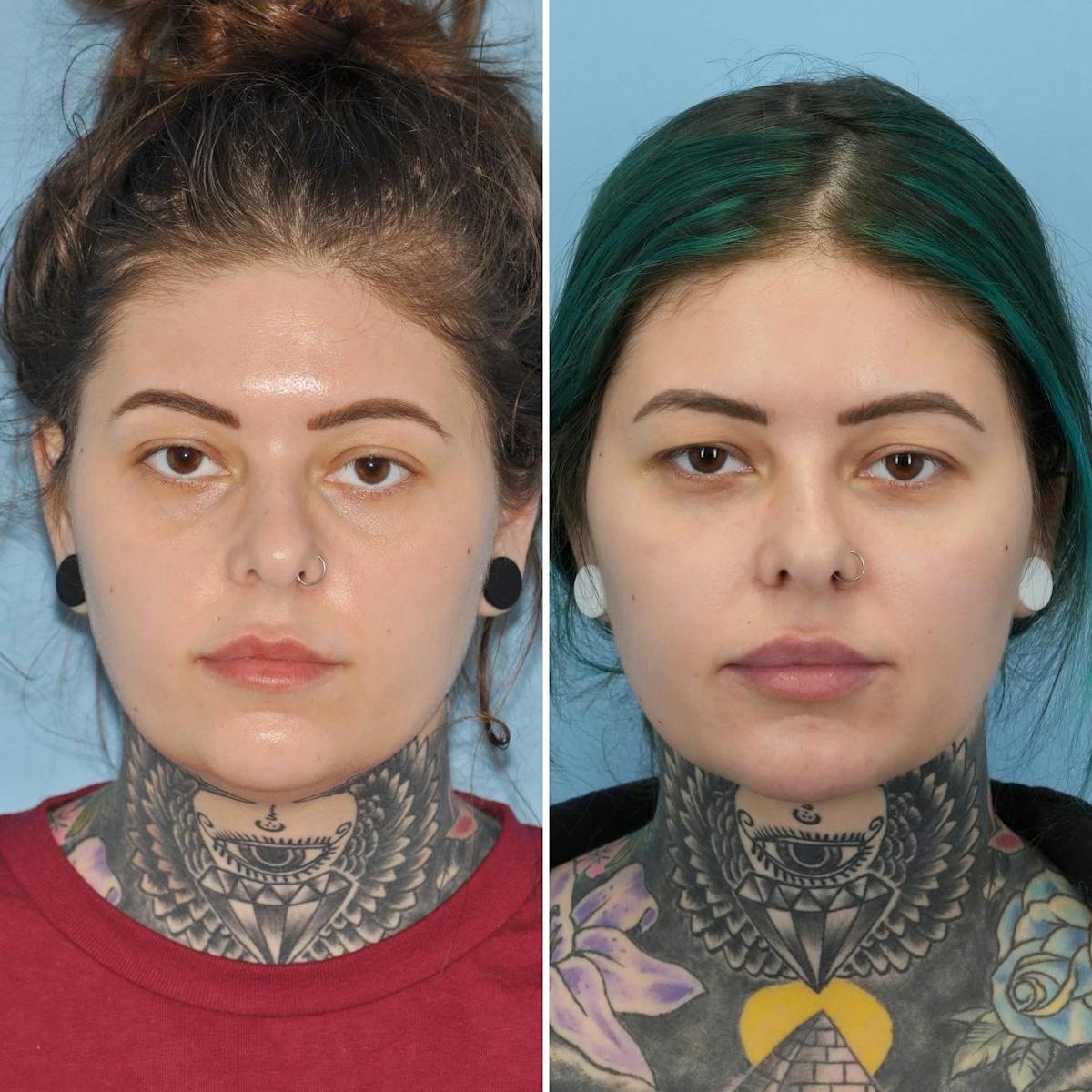 THERMItight Before & After Gallery - Patient 170074 - Image 5