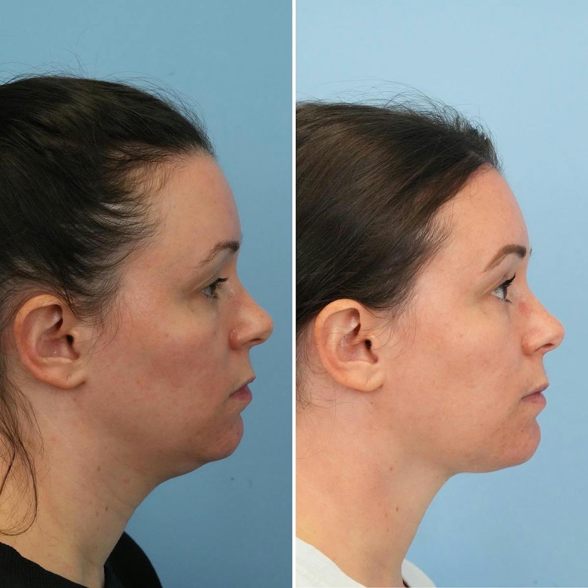 THERMItight Before & After Gallery - Patient 325695 - Image 1