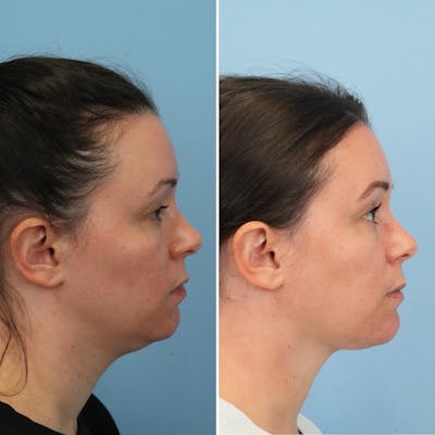 THERMItight Before & After Gallery - Patient 325695 - Image 1