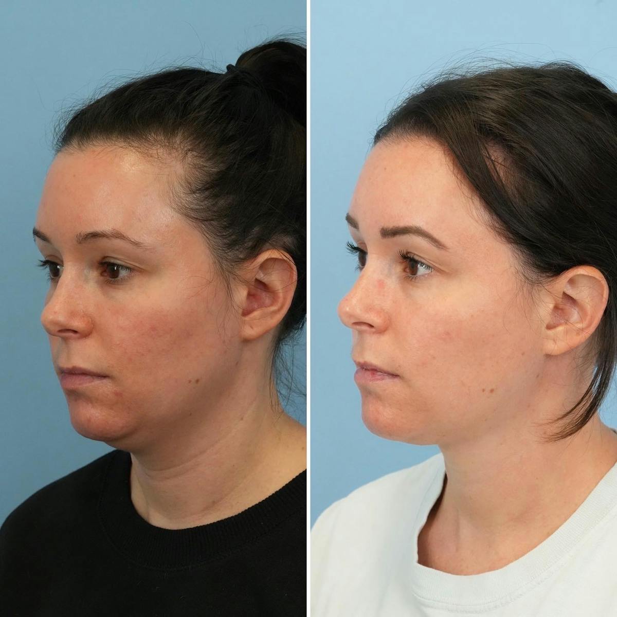 THERMItight Before & After Gallery - Patient 325695 - Image 2