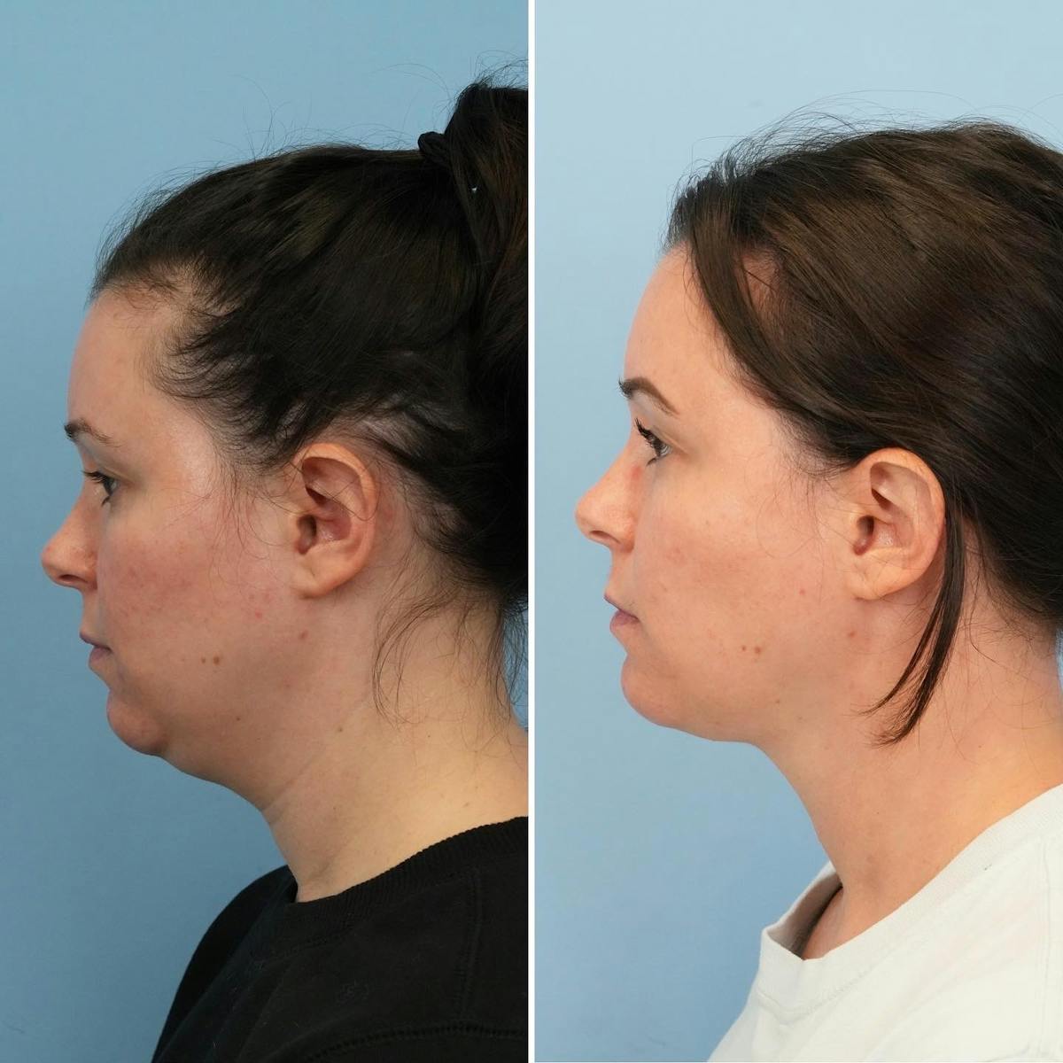 THERMItight Before & After Gallery - Patient 325695 - Image 3