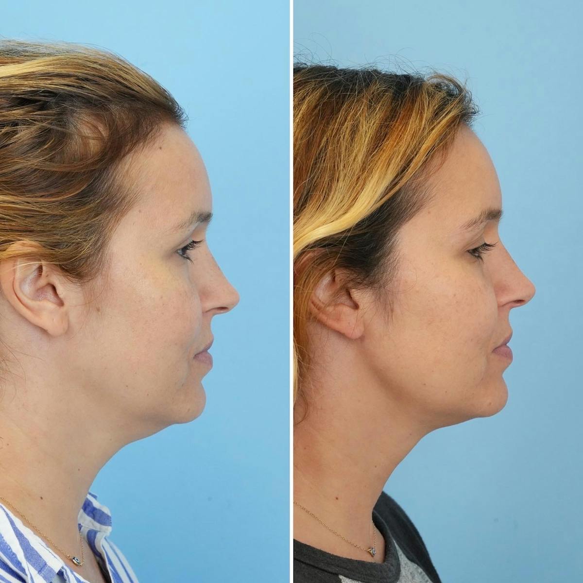 THERMItight Before & After Gallery - Patient 212068 - Image 1