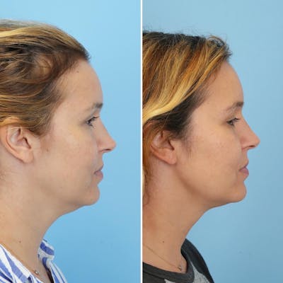 THERMItight Before & After Gallery - Patient 212068 - Image 1