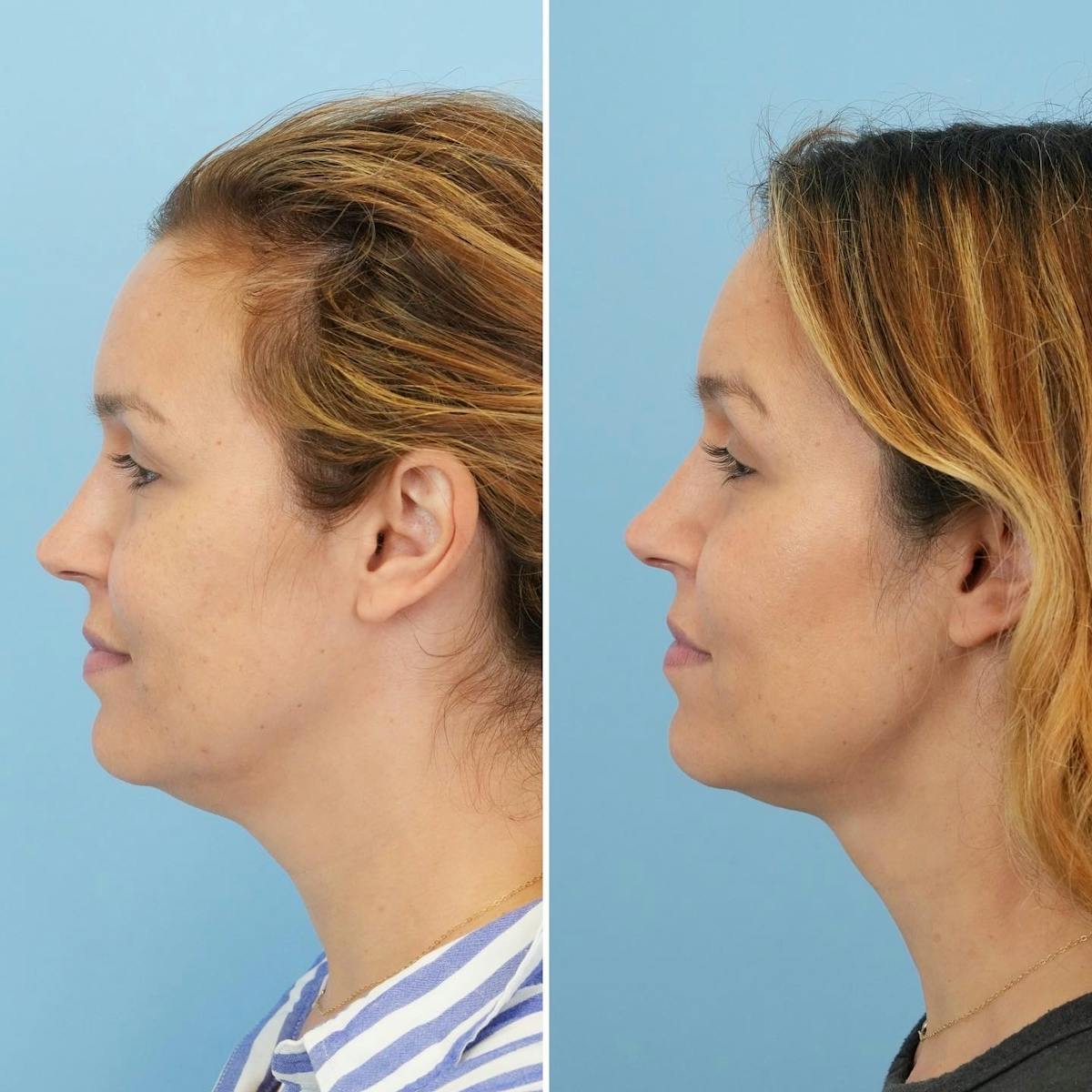 THERMItight Before & After Gallery - Patient 212068 - Image 2