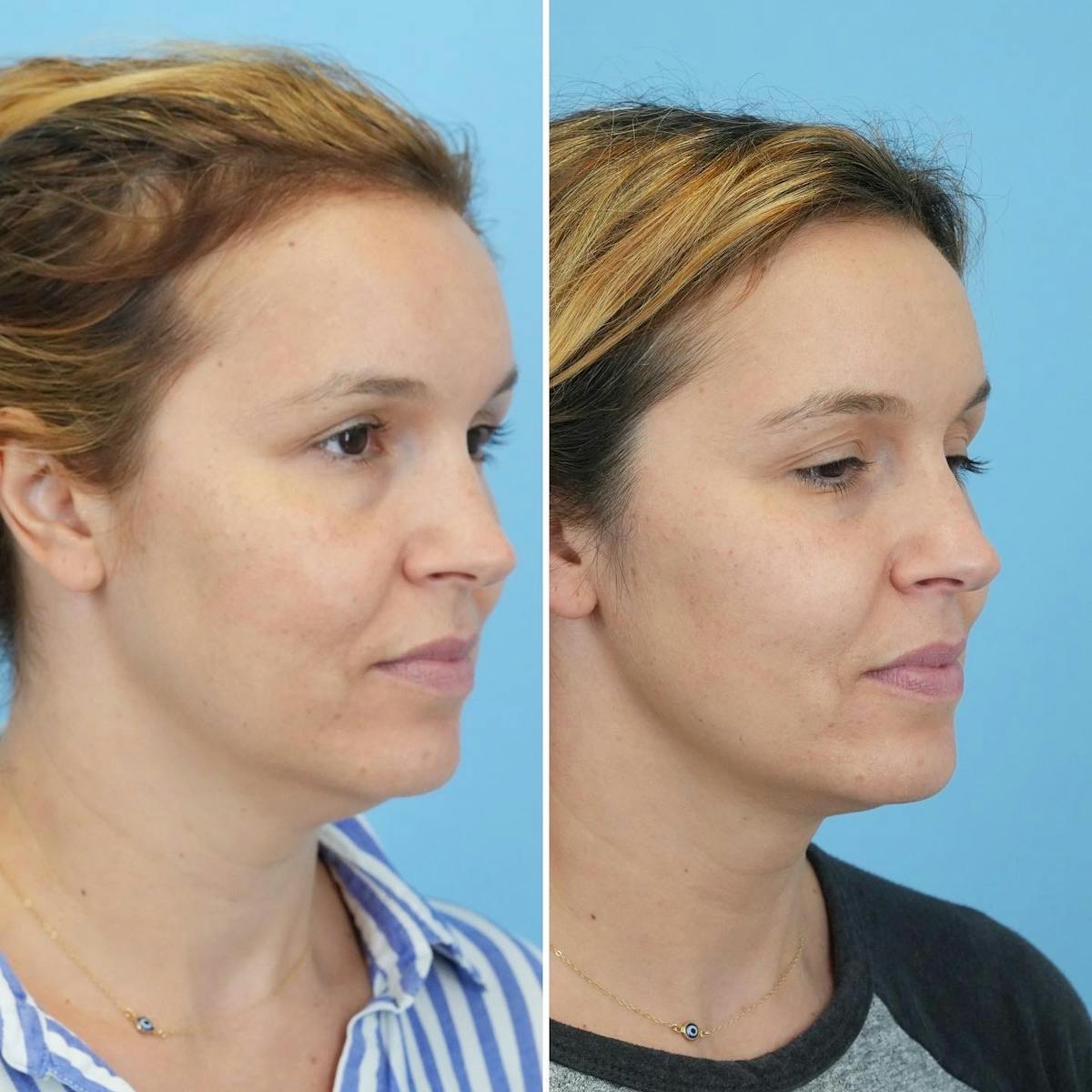 THERMItight Before & After Gallery - Patient 212068 - Image 3