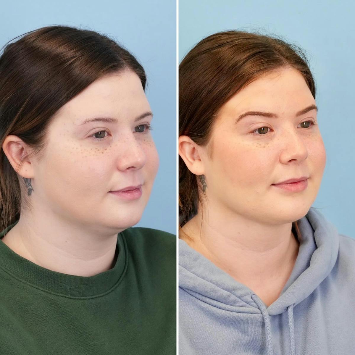 THERMItight Before & After Gallery - Patient 176016 - Image 2