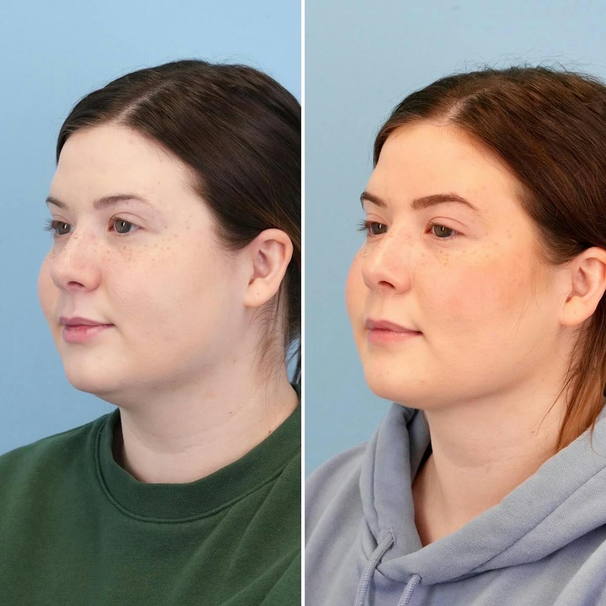 THERMItight Before & After Gallery - Patient 176016 - Image 5