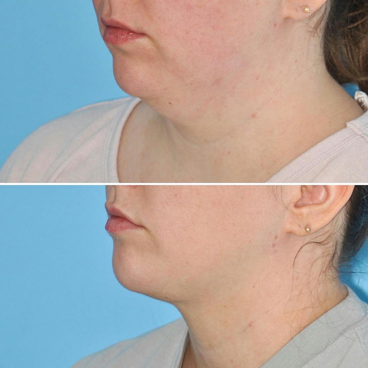 THERMItight Before & After Gallery - Patient 200863 - Image 1