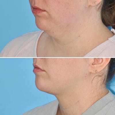 THERMItight Before & After Gallery - Patient 200863 - Image 1