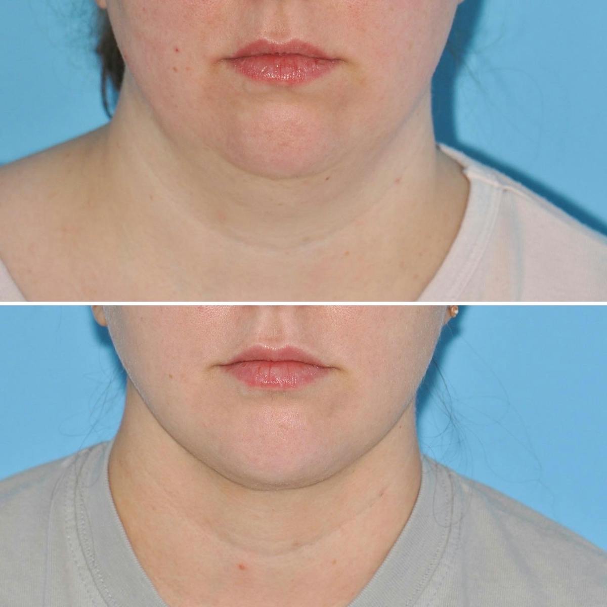THERMItight Before & After Gallery - Patient 200863 - Image 2