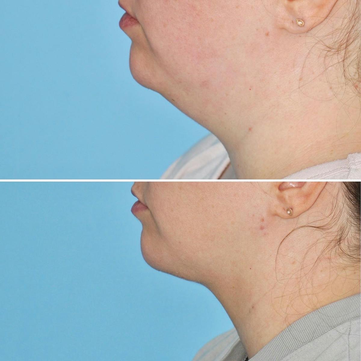 THERMItight Before & After Gallery - Patient 200863 - Image 3