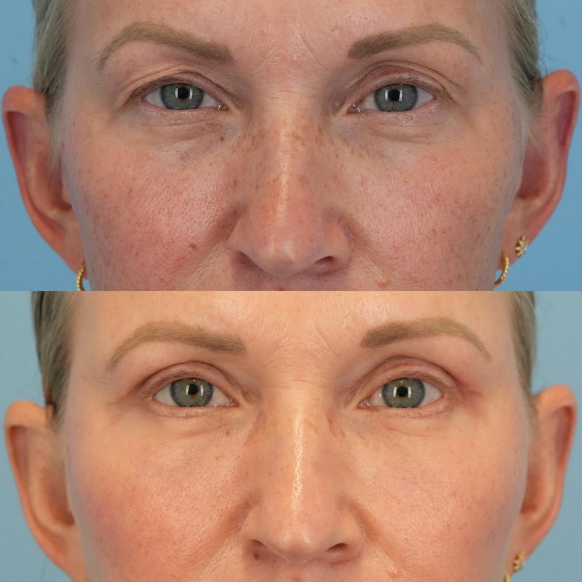 Blepharoplasty Before & After Gallery - Patient 655395 - Image 1
