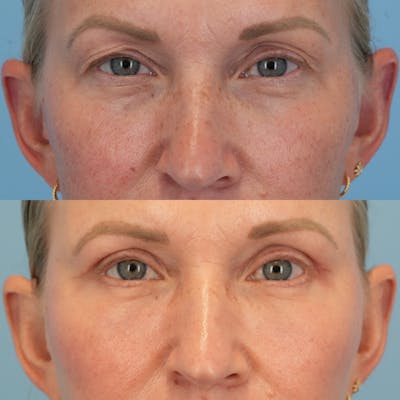 Blepharoplasty Before & After Gallery - Patient 655395 - Image 1