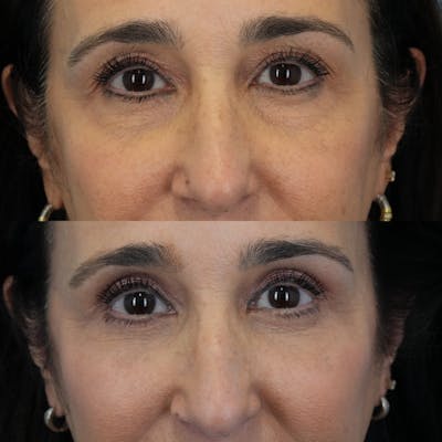 Blepharoplasty Before & After Gallery - Patient 380186 - Image 1