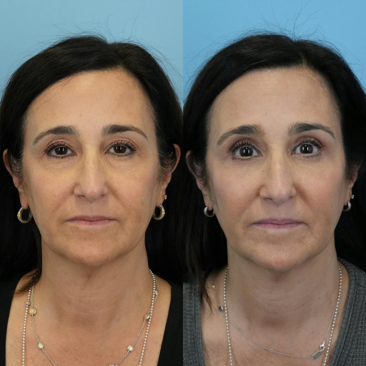 Blepharoplasty Before & After Gallery - Patient 380186 - Image 6