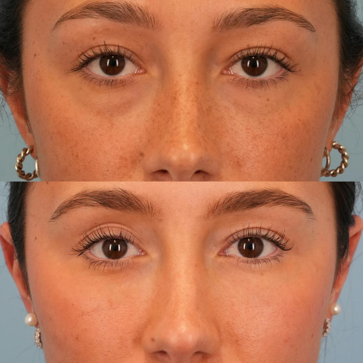 Blepharoplasty Before & After Gallery - Patient 133103 - Image 1