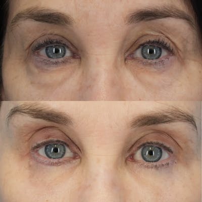 Blepharoplasty Before & After Gallery - Patient 119532 - Image 1