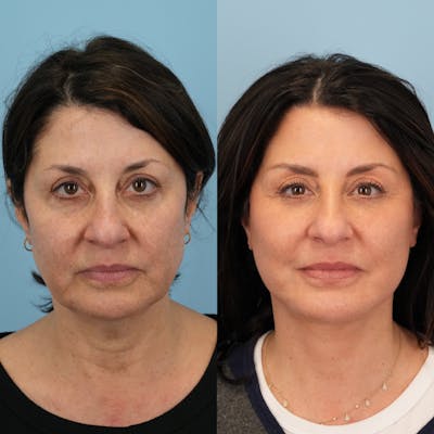 Facelift Before & After Gallery - Patient 258538 - Image 1