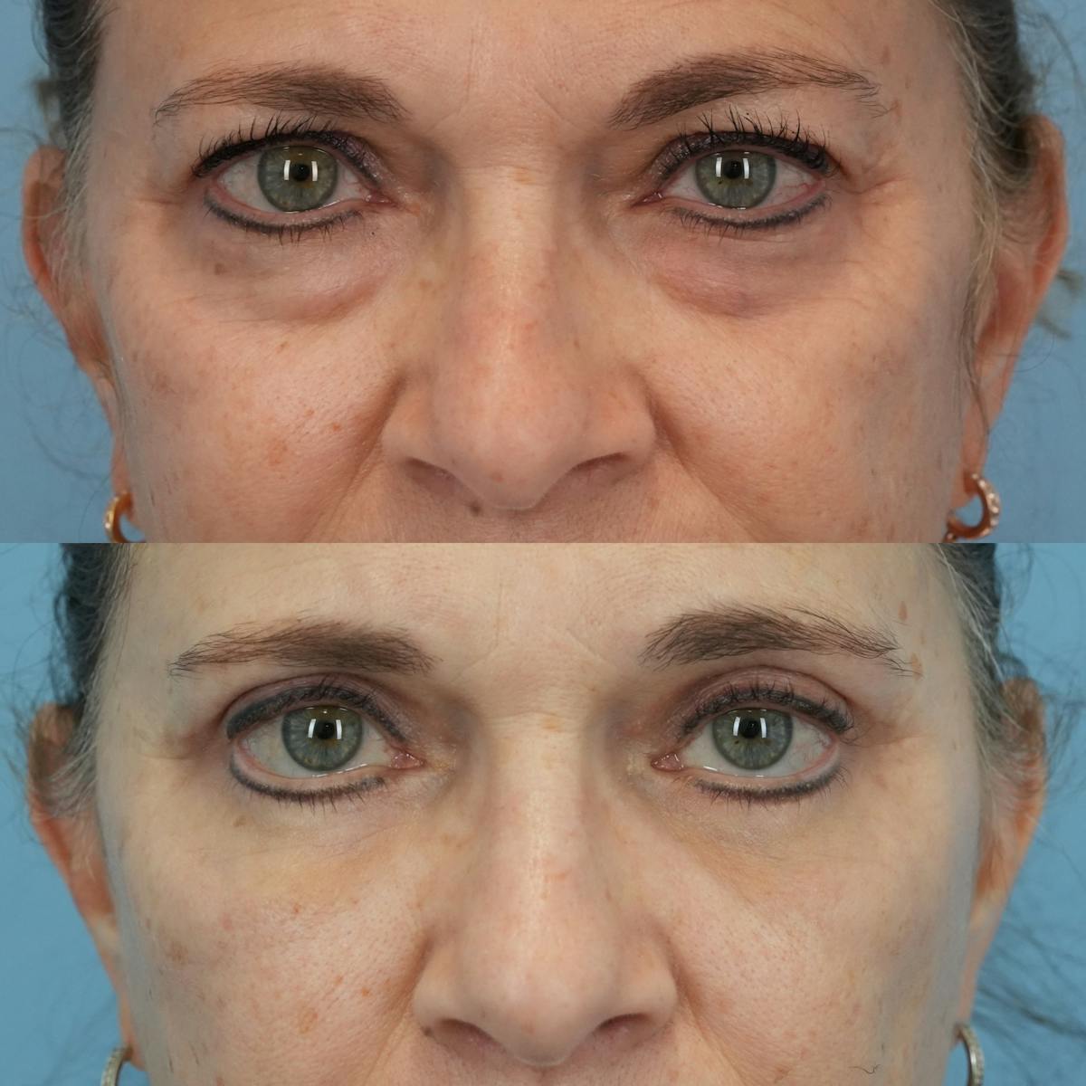 Blepharoplasty Before & After Gallery - Patient 280827 - Image 1