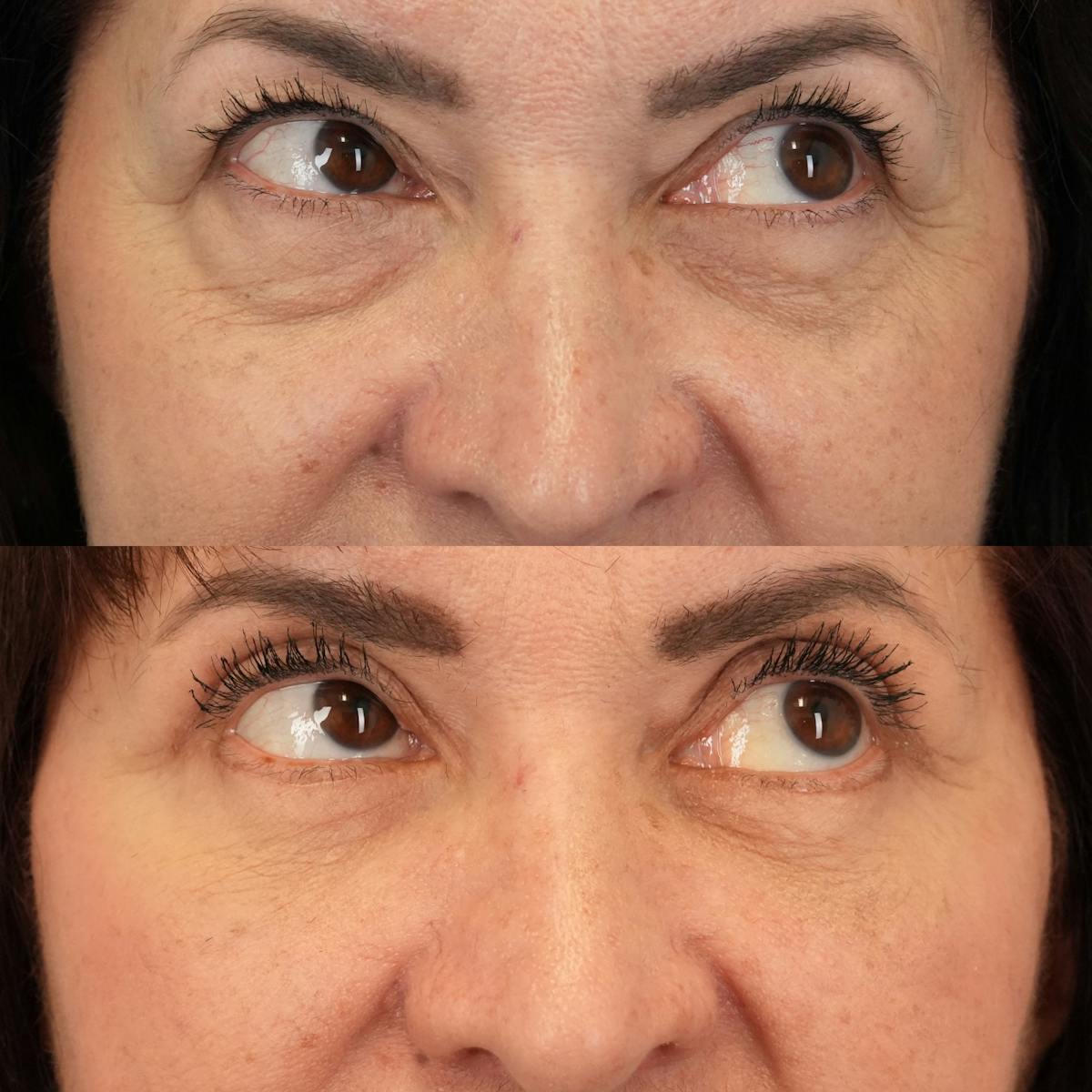 Blepharoplasty Before & After Gallery - Patient 289649 - Image 4