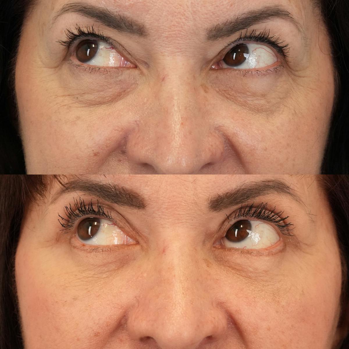 Blepharoplasty Before & After Gallery - Patient 289649 - Image 5