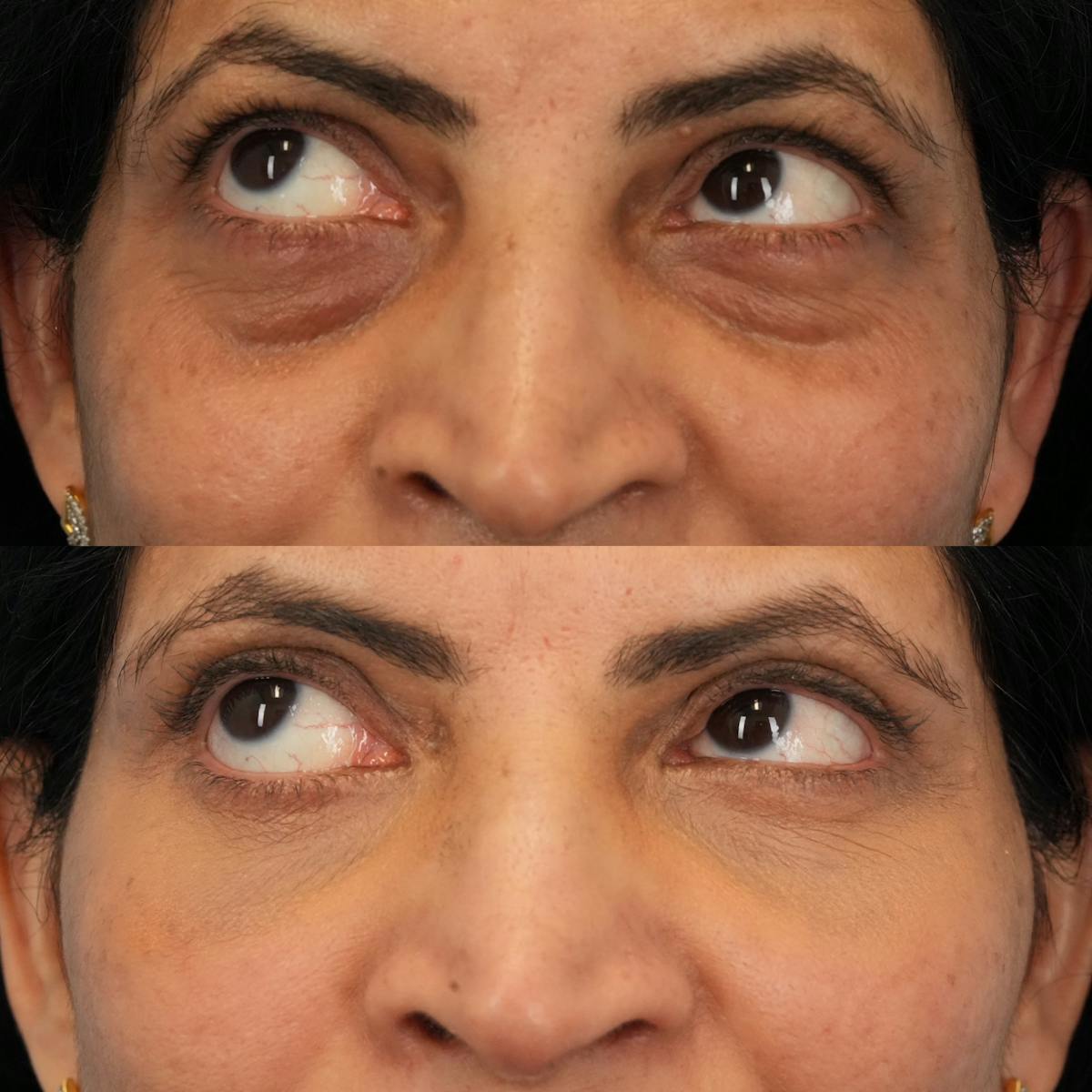Blepharoplasty Before & After Gallery - Patient 321479 - Image 5