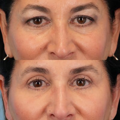 Blepharoplasty Before & After Gallery - Patient 613829 - Image 1
