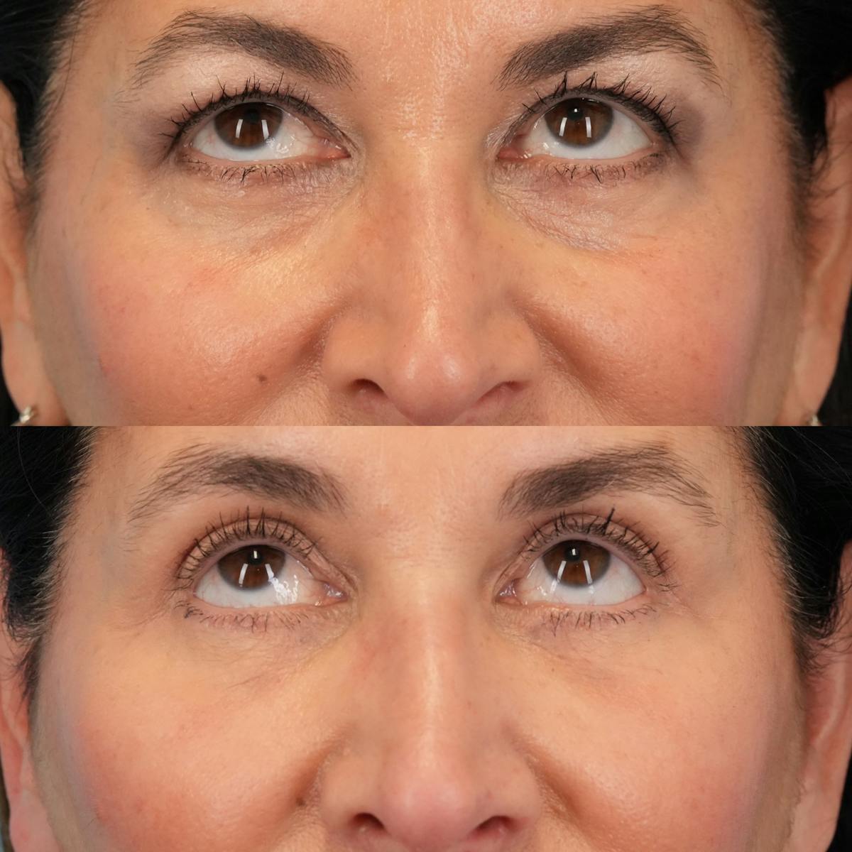 Blepharoplasty Before & After Gallery - Patient 613829 - Image 2