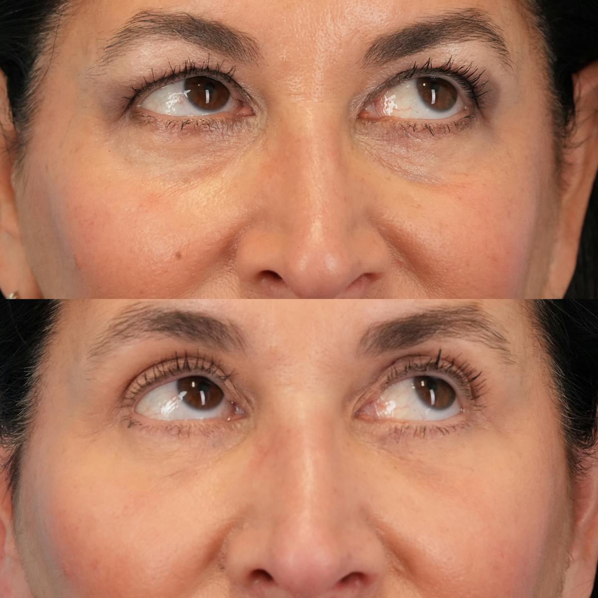 Blepharoplasty Before & After Gallery - Patient 613829 - Image 4