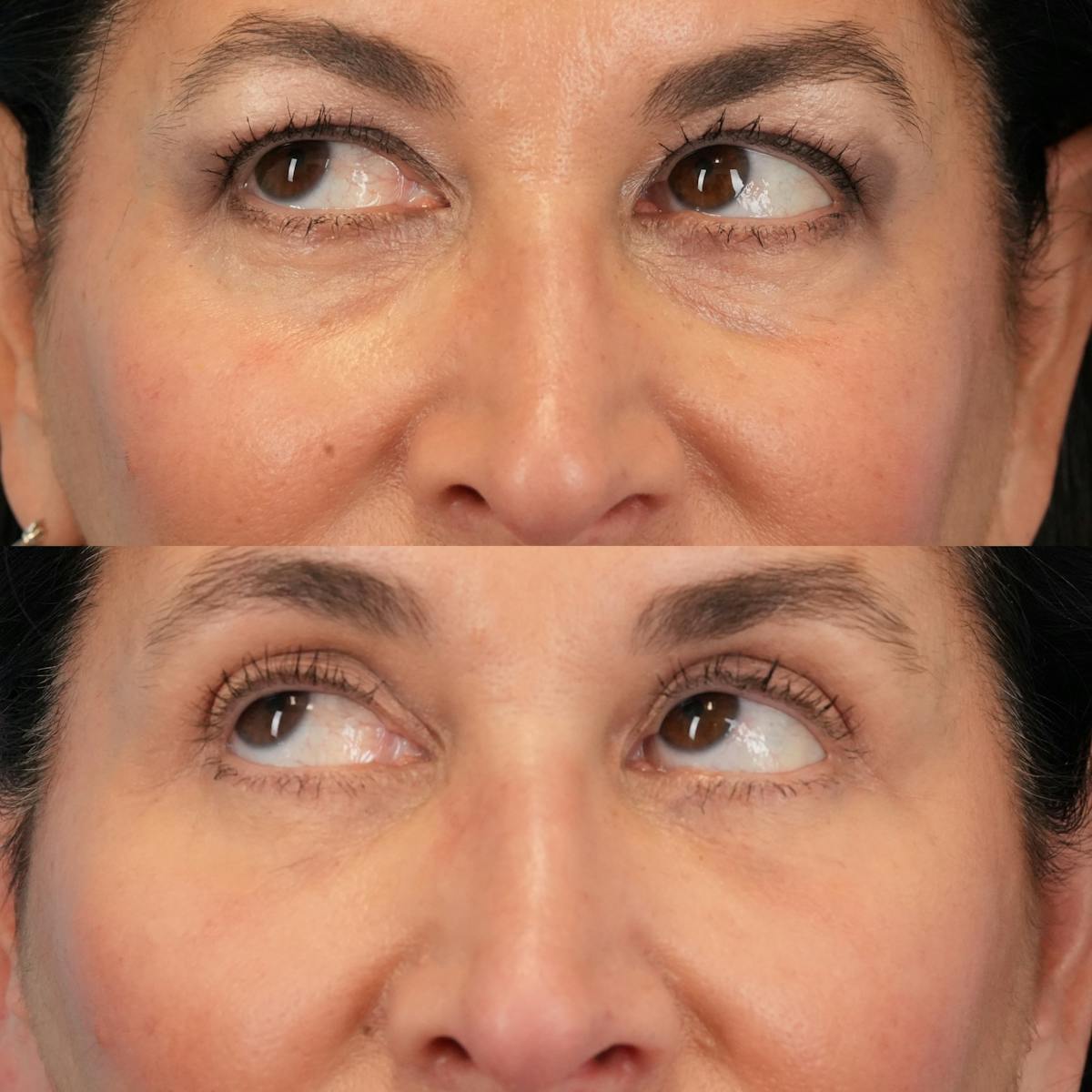 Blepharoplasty Before & After Gallery - Patient 613829 - Image 5