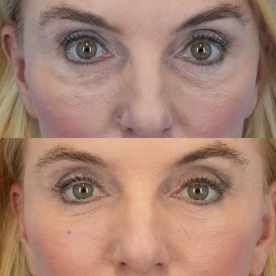 Blepharoplasty Before & After Gallery - Patient 616060 - Image 1